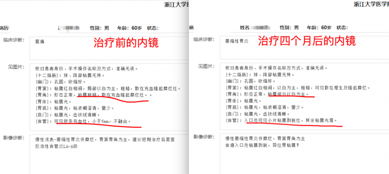 慢性萎缩性胃炎的治疗：患者的康复之路